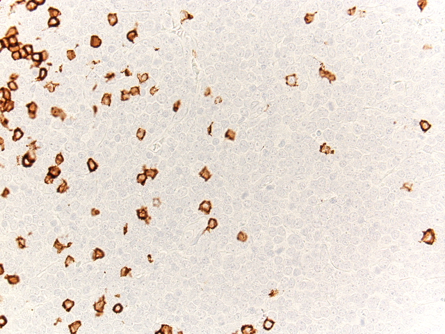 Lymph node biopsy, lymphoid-predominant area, CD20
